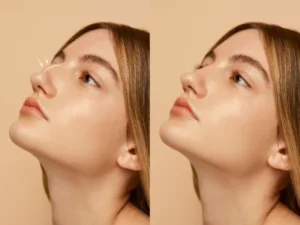 Rhinoplasty